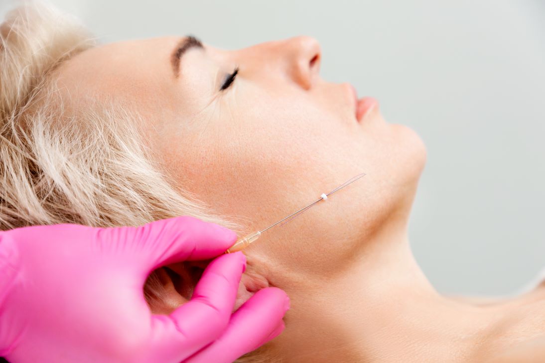 THREAD LIFT